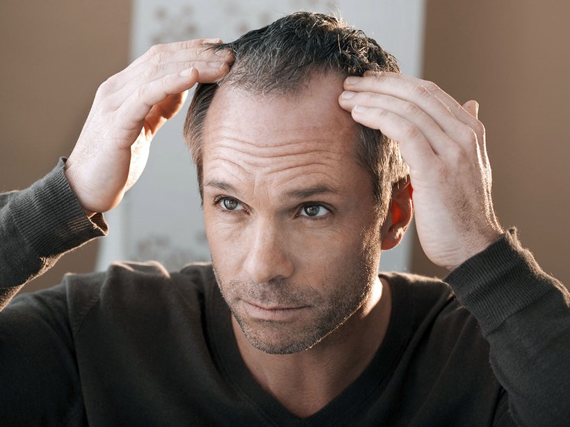 Für Haarausfall gibt es eine Vielzahl von möglichen Ursachen.